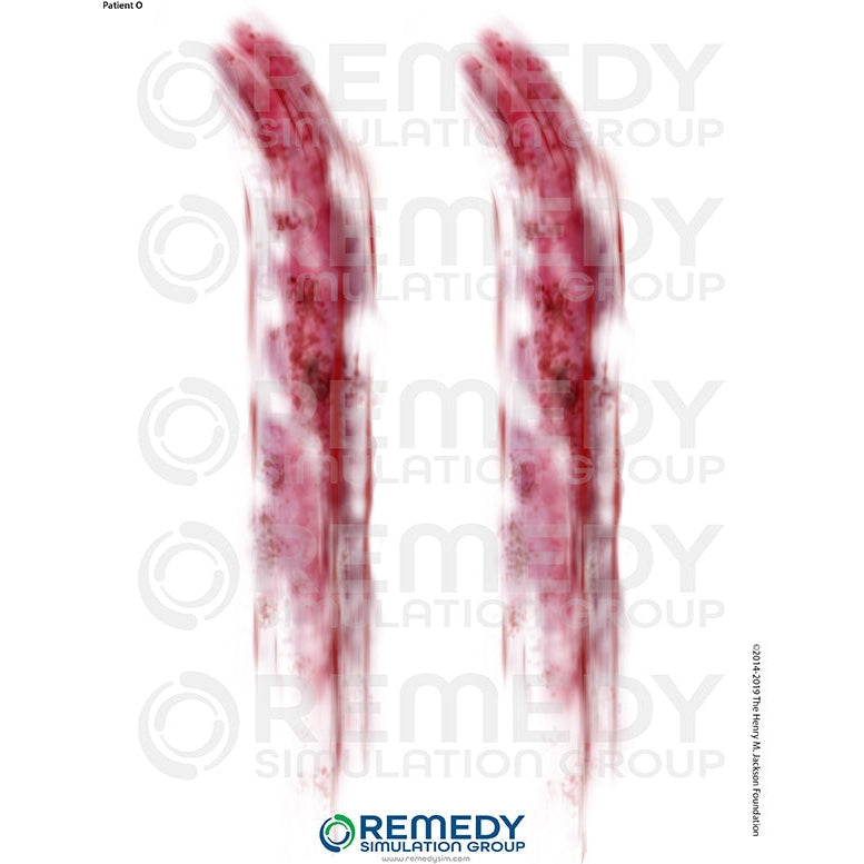 Wallcur-Moulage Tattoos - Patient O Scenario-MedTech-1